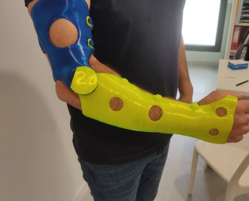 Dispositif orthopedique ou Orthese réalisée en impression 3D par Design Ortho