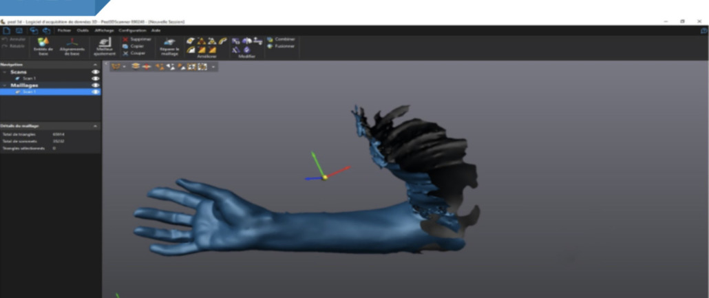 Orthèses imprimées en 3D : notre sélection de projets - 3Dnatives